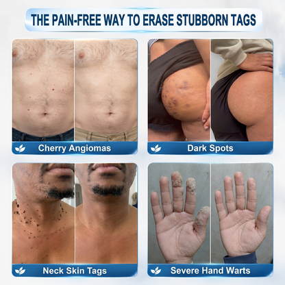 🍓 PEARLMOON®  𝐁𝐨𝐭𝐚𝐧𝐢𝐜𝐚𝐥 𝐌𝐢𝐜𝐫𝐨𝐧𝐞𝐞𝐝𝐥𝐞 𝐇𝐲𝐝𝐫𝐨𝐜𝐨𝐥𝐥𝐨𝐢𝐝 𝐏𝐚𝐭𝐜𝐡 (𝐅𝐨𝐫 𝐒𝐤𝐢𝐧 𝐓𝐚𝐠𝐬, 𝐖𝐚𝐫𝐭𝐬, 𝐌𝐨𝐥𝐞𝐬, 𝐀𝐠𝐞 𝐒𝐩𝐨𝐭𝐬 & 𝐏𝐢𝐠𝐦𝐞𝐧𝐭𝐚𝐭𝐢𝐨𝐧 𝐂𝐨𝐧𝐜𝐞𝐫𝐧𝐬)